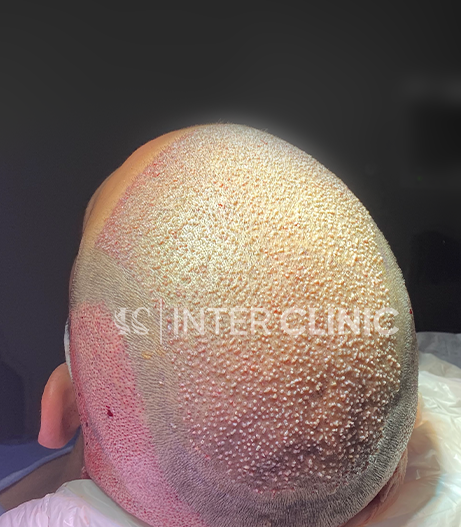 زراعة الشعر بتقنية FUE المدعومة بالبلازما الغنية بالصفائح الدموية