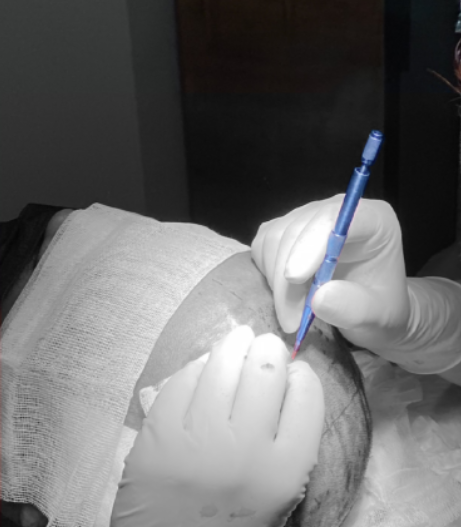 زراعة الشعر بتقنية FUE بالياقوت الأزرق