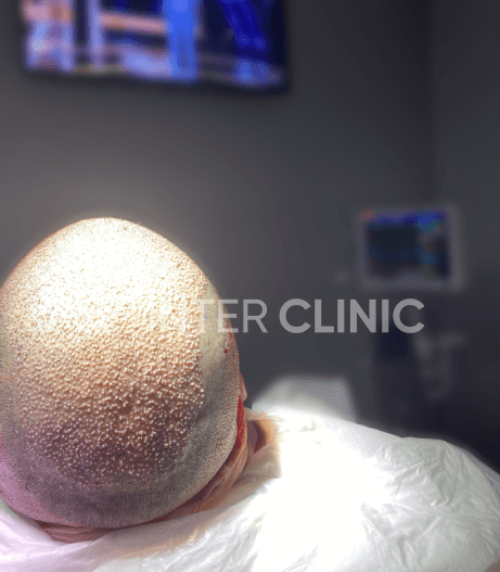 زراعة الشعر بالتنويم