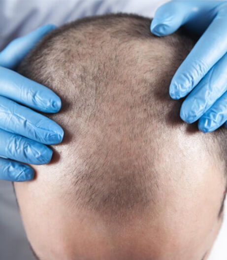 زراعة الشعر بتقنية DHI